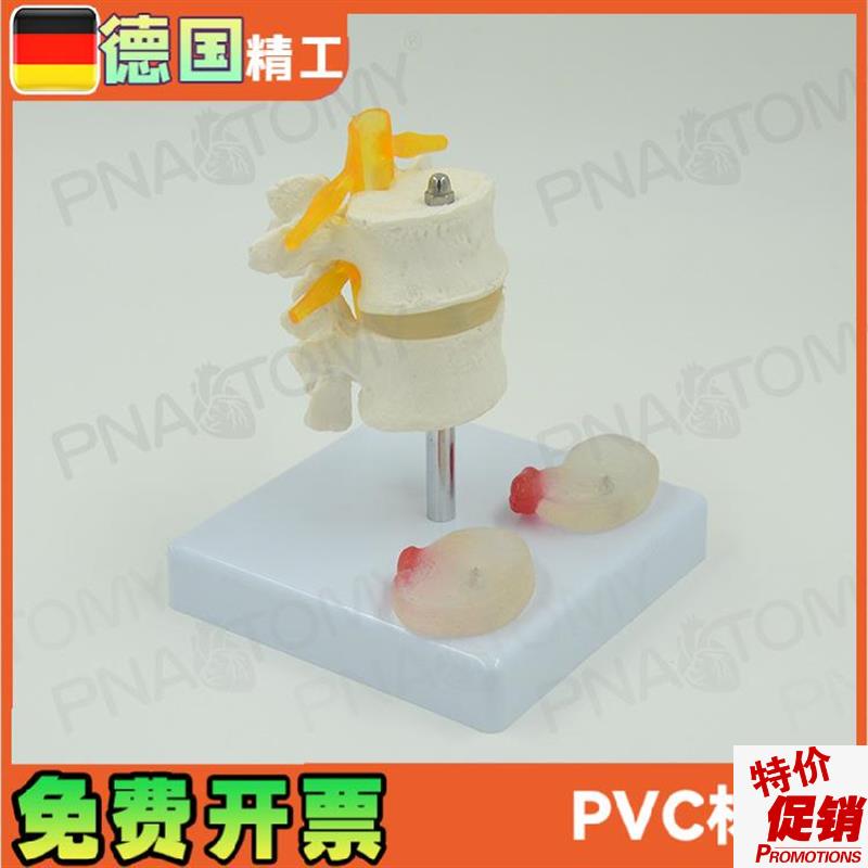 德国】人体腰g椎盘突出模型两节腰椎骨骼骨科推拿演示教学医学模