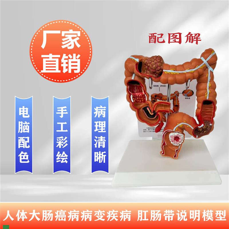 人体结肠病变模型肛肠科消化内科C大肠模型医学人体解剖学病理内