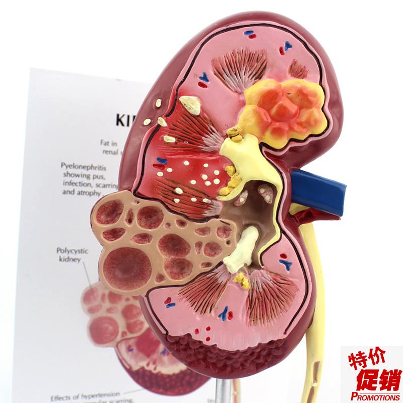 ENOVO颐诺医学人体r肾脏解剖模型肾炎肾部模型肾脏病理泌尿外科男
