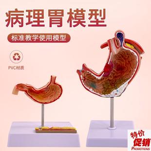 人体胃解a剖模型胃的病变模型胃部疾病演示模型病理胃胃的穿孔