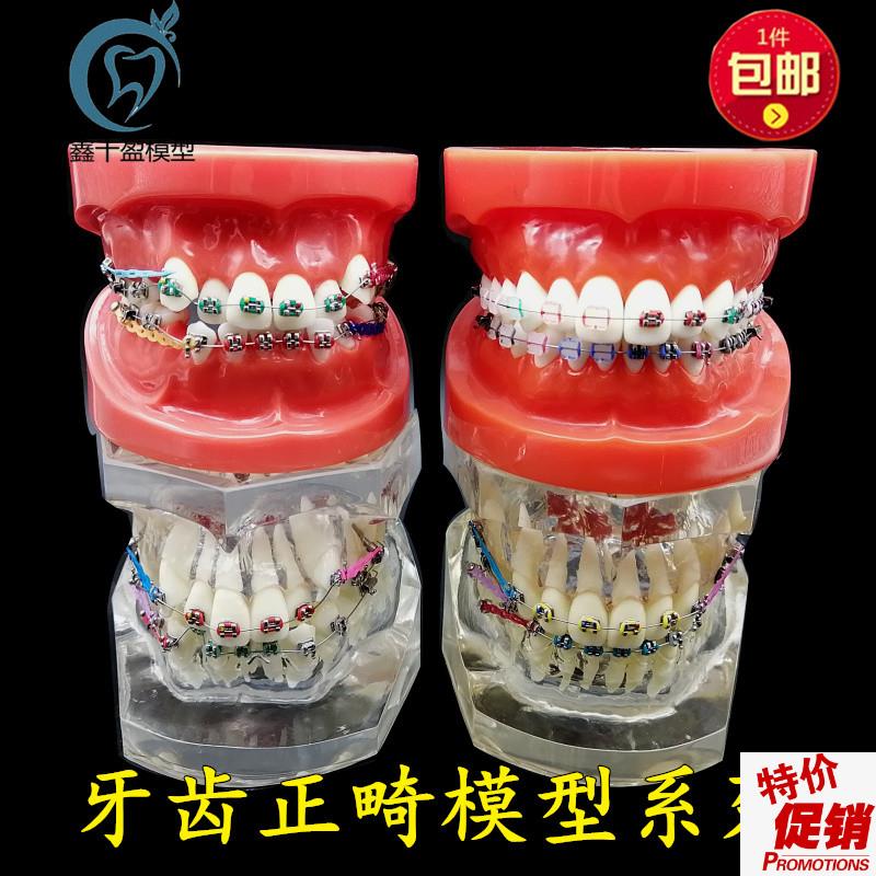 牙科正畸模型透明错o颌矫正展示模型结扎丝托槽正畸带支抗钉牙列