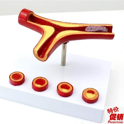 ENOVOd颐诺冠状动脉性心血管动脉硬化模型老年心脏模型血栓心内科