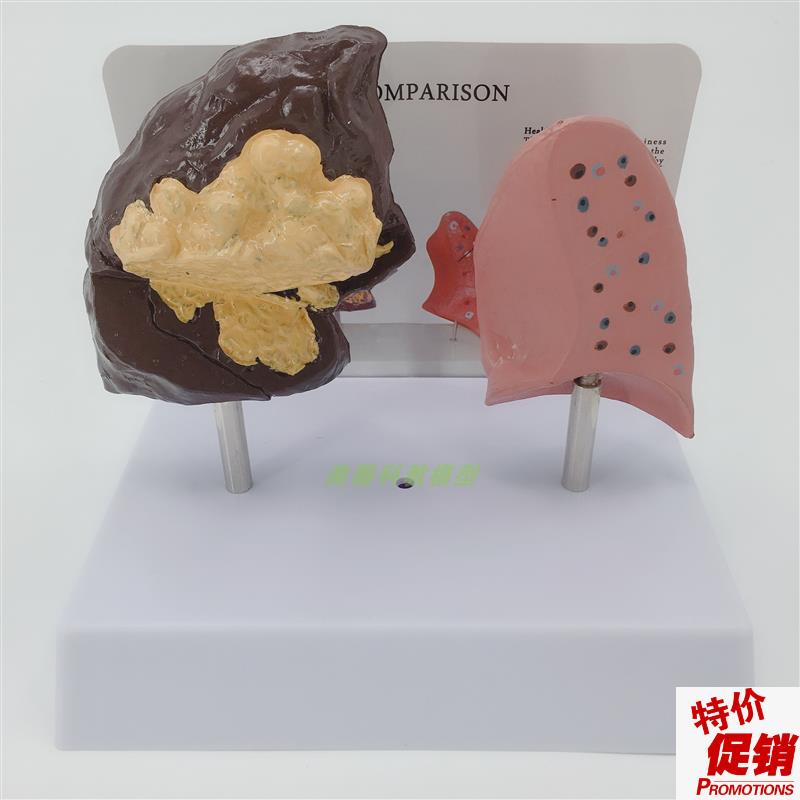 健康肺与病理肺比较模型正常病态肺脏对比病理肺解.剖切面模型
