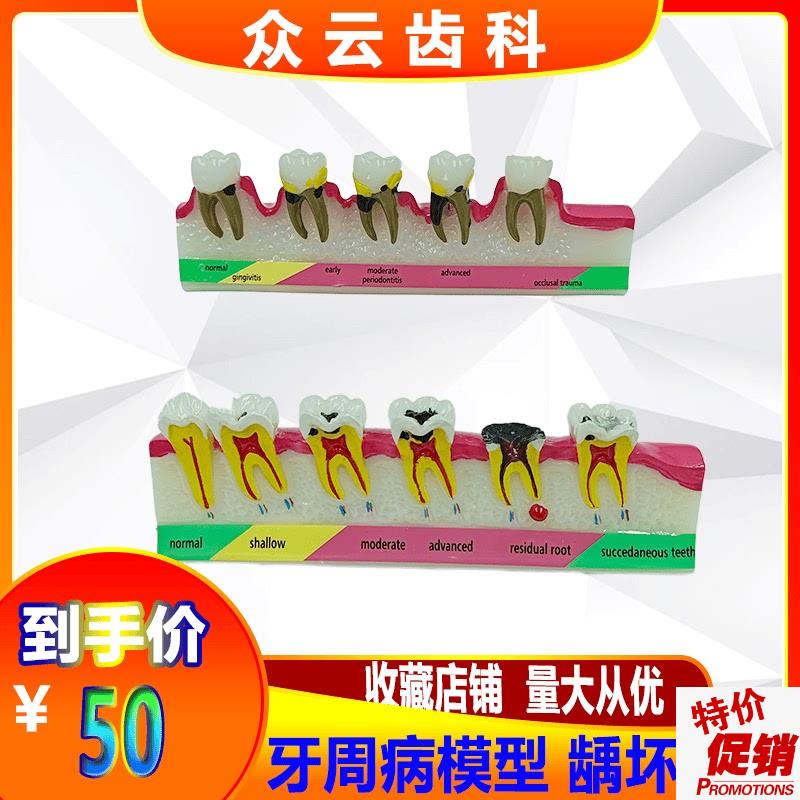 牙齿牙科牙周分类龋坏模型变重过程牙科口腔医患沟U通展示模型包