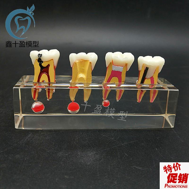 牙科教学模型乳牙龋病模型可拆分牙髓修复医患沟通M4.018包邮