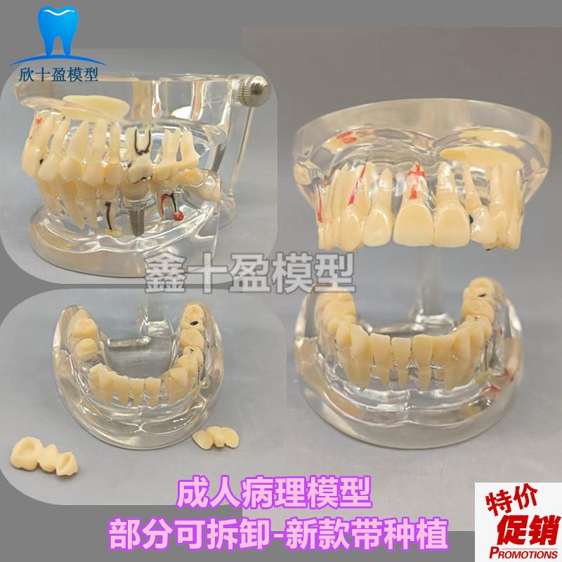 牙科牙齿病理模型成人全口牙模型牙模医患沟通教育R教学种植修复C