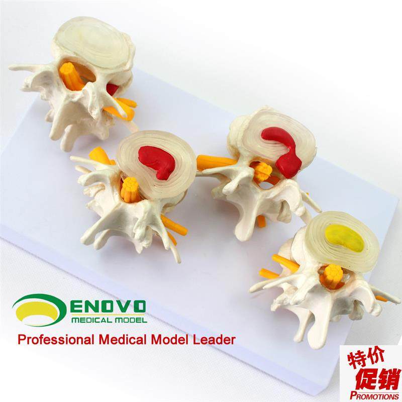 ENOVO颐e诺医学人体腰椎模型椎体椎间盘病变髓核膨出脱出软骨板,文具电教/文化用品/商务用品,教学标本/模型,淘宝优惠券,粉丝福利购,淘宝优惠卷