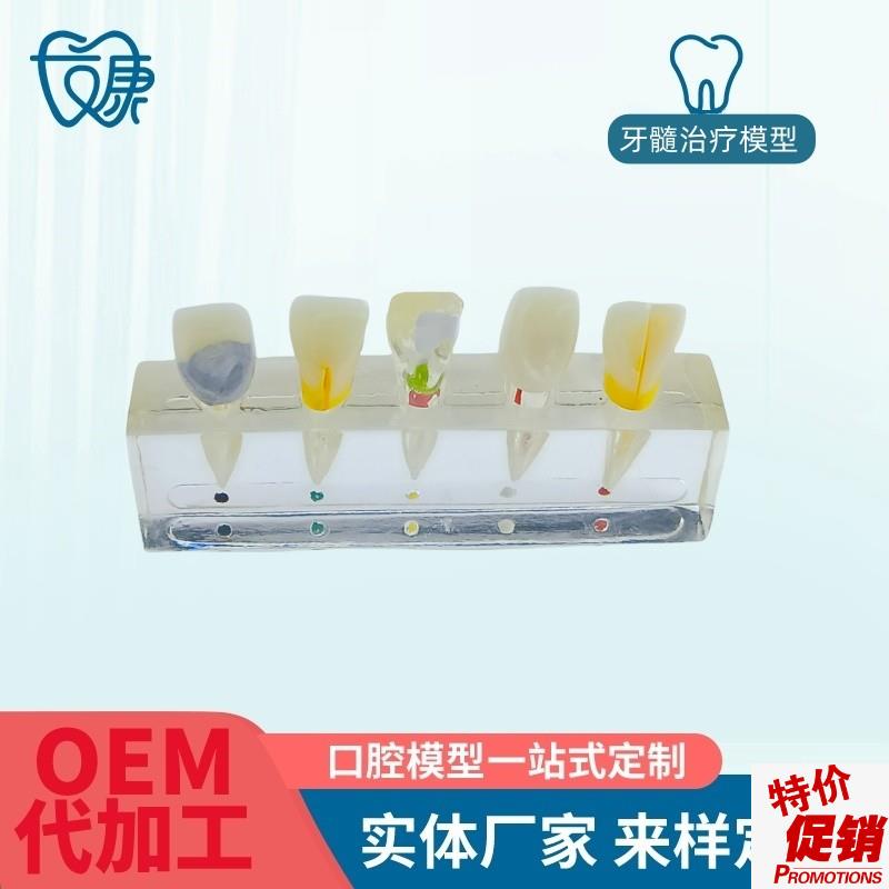 牙科医患沟通病理模型牙髓病修复模型展O示牙髓牙髓治疗模型