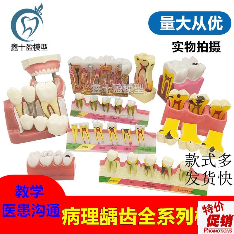 牙科病理模型综合病理种植与修复牙周分类N龋齿演示蛀牙备牙模型