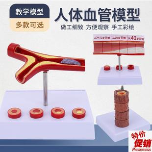 血管/堵塞动支脉粥样/硬化心血管动脉/硬化模型血管病.理模型血栓