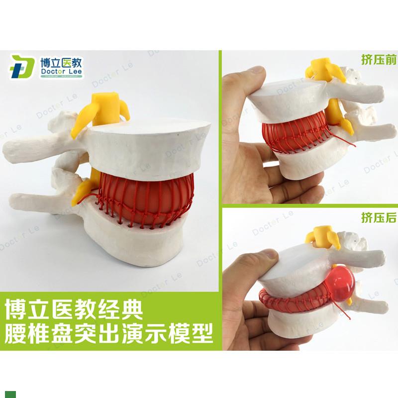 腰椎放大腰椎间盘(突)出演示模型人体P脊柱脊椎骨病理模型