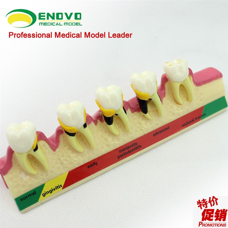 颐诺正品口腔h牙周学疾病分类模型牙龈炎度慢性牙周炎模型