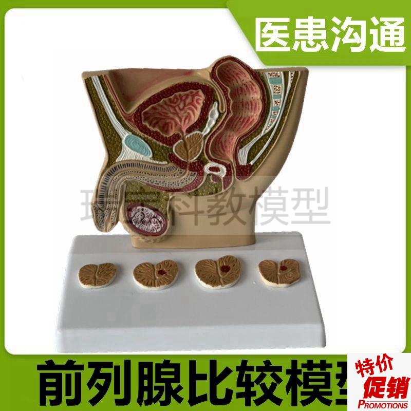男性前列腺模型变大尿道s狭窄男科医患沟通临床医药礼品生殖泌尿