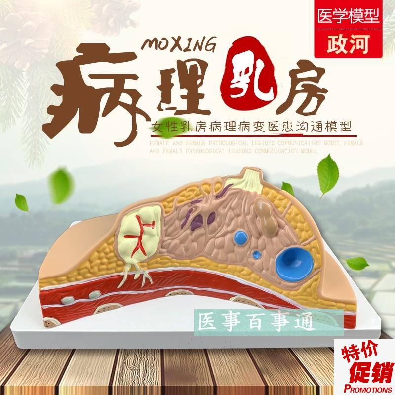 义乳病变模型女性月嫂培训病理模型催乳师护T理模型培训模具