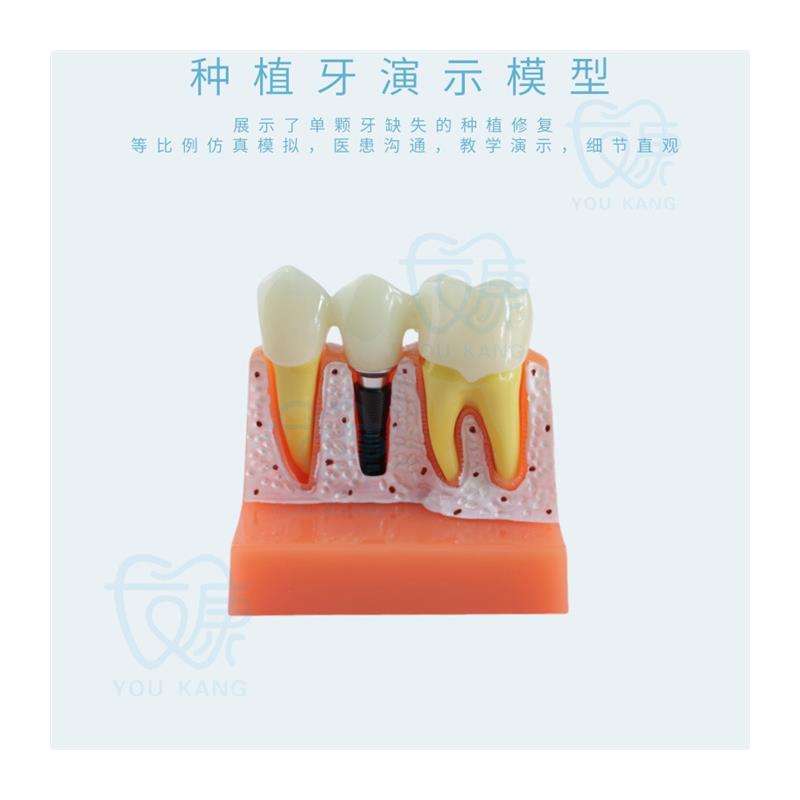 种植牙4倍种植解模型义齿修复种植牙解说可拆.卸连桥牙冠