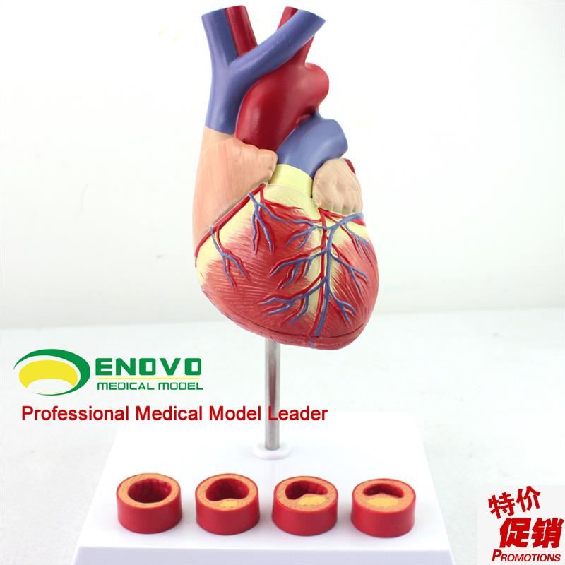 颐诺正品c1:1医用人体心脏模型动脉粥样硬化模型血栓心内科教学