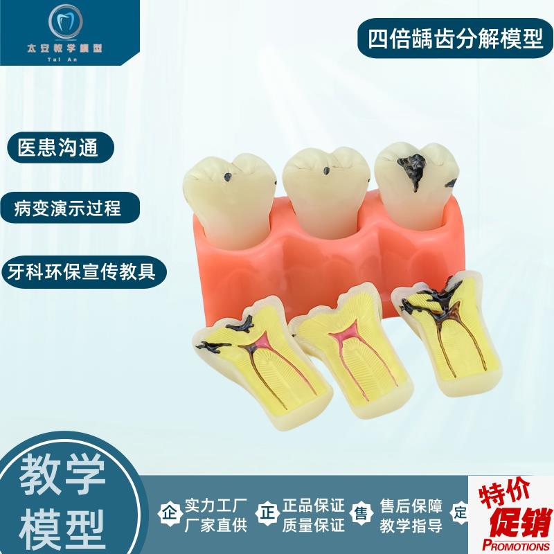 牙模型牙科口腔教学模型v窝沟封闭模型龋齿对比模型龋齿模型