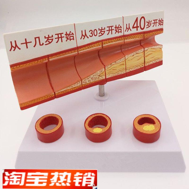 动脉血管模型不同年龄段血管内膜变化粥样硬化栓子W血管狭窄斑块