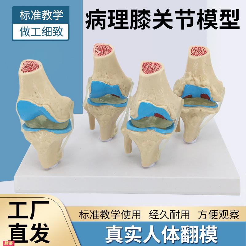 人体病理膝关节模型病变膝关节退行性膝关节/病关节镜手术沟通