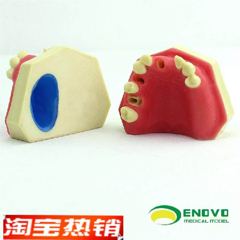 ENOVO颐诺口腔即刻种植练习操作E模型上颌骨上颌窦牙列缺失种植体,文具电教/文化用品/商务用品,教学标本/模型,淘宝优惠券,粉丝福利购,淘宝优惠卷