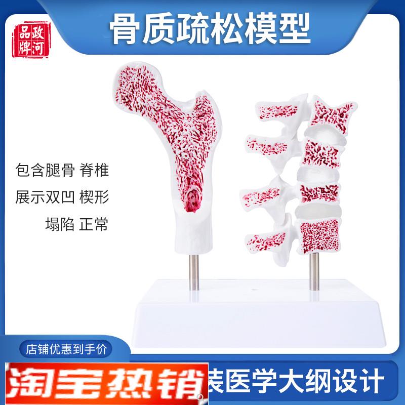骨质疏松模型人体骨骼教学模型股骨F头脊椎双凹塌陷楔形病理病变