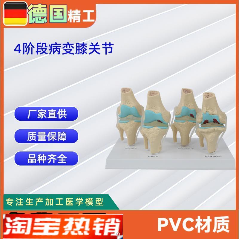 德国】人体4阶段病变t膝关节模型生物医学教学器材模具