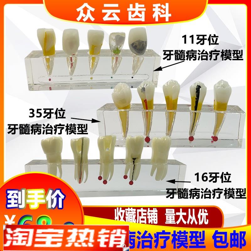 牙科口腔牙髓g病治疗模型解剖前磨牙龋坏牙冠髓腔充填可拆牙列模