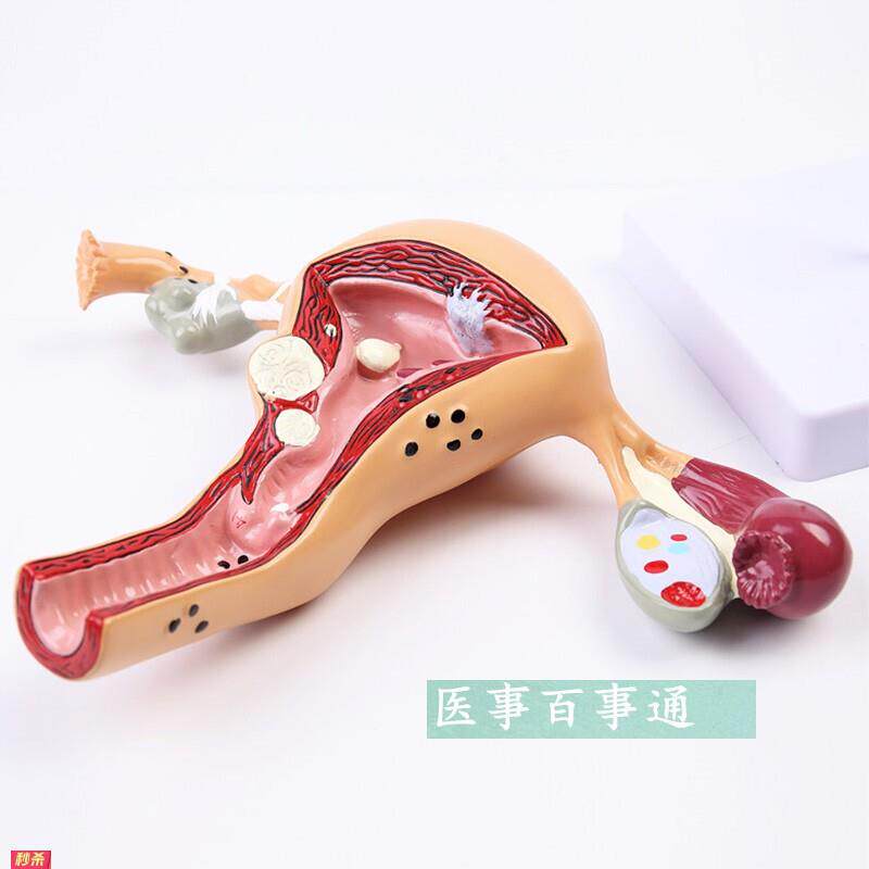 子宫卵巢常见病模型女性生殖系统计生模型教学医用模型子宫模型