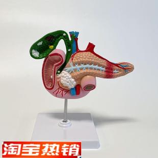 康泰模型胆囊十二指肠胰腺消化道医药促销病O理内分泌胆管石块阻