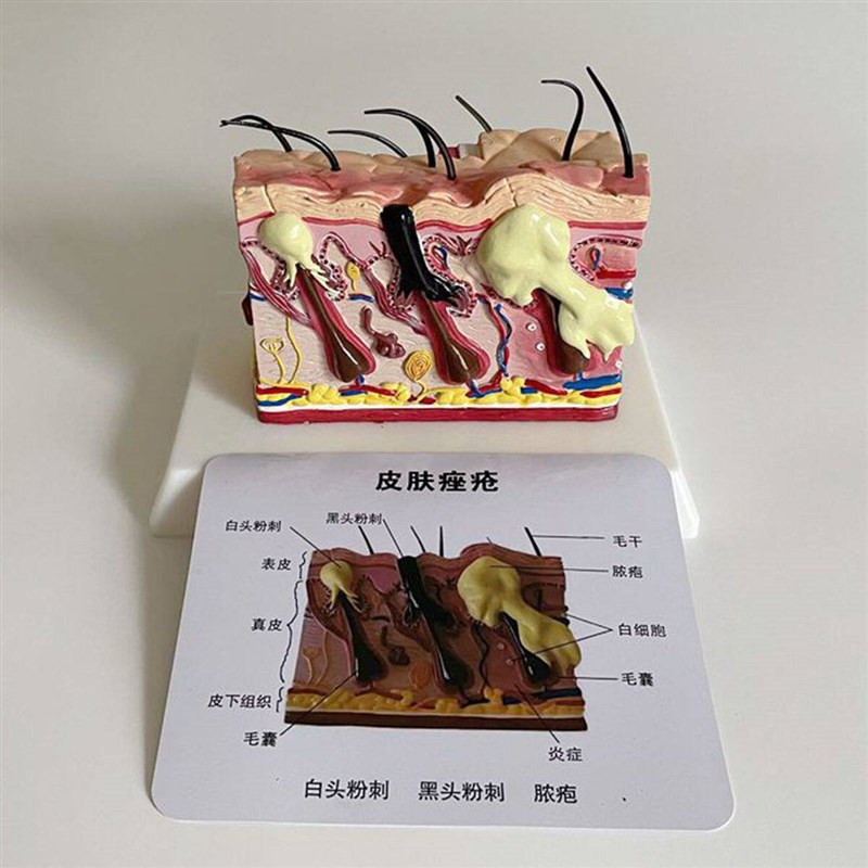 青春痘皮肤痤疮 黑头n粉刺 丘疹 脓疱 病理毛囊皮脂腺面部皮肤护