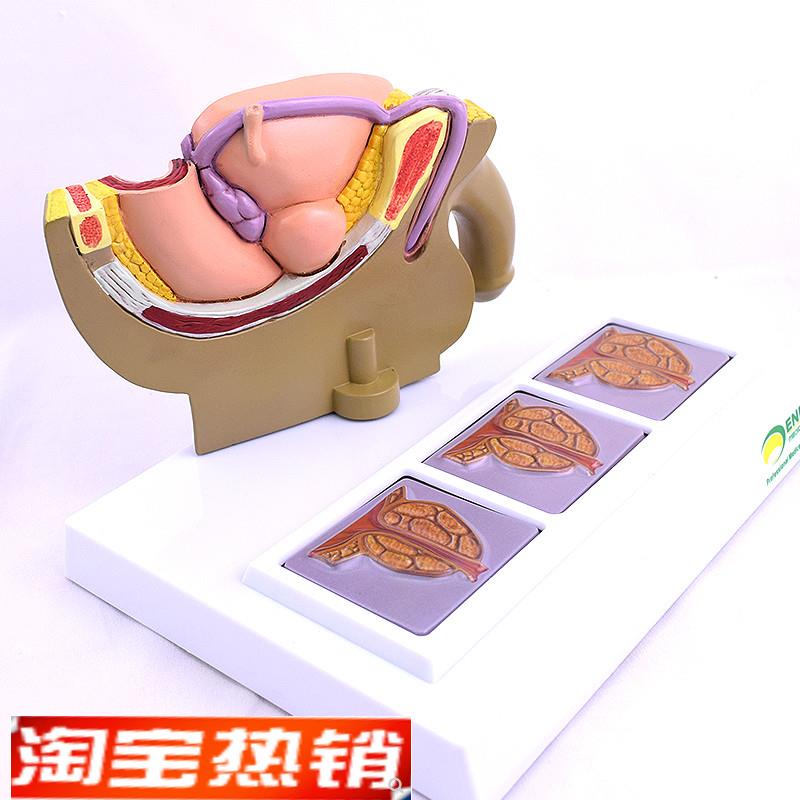 ENOVO颐诺人体男性前列x腺模型前列腺增生肥大模型BHP模型