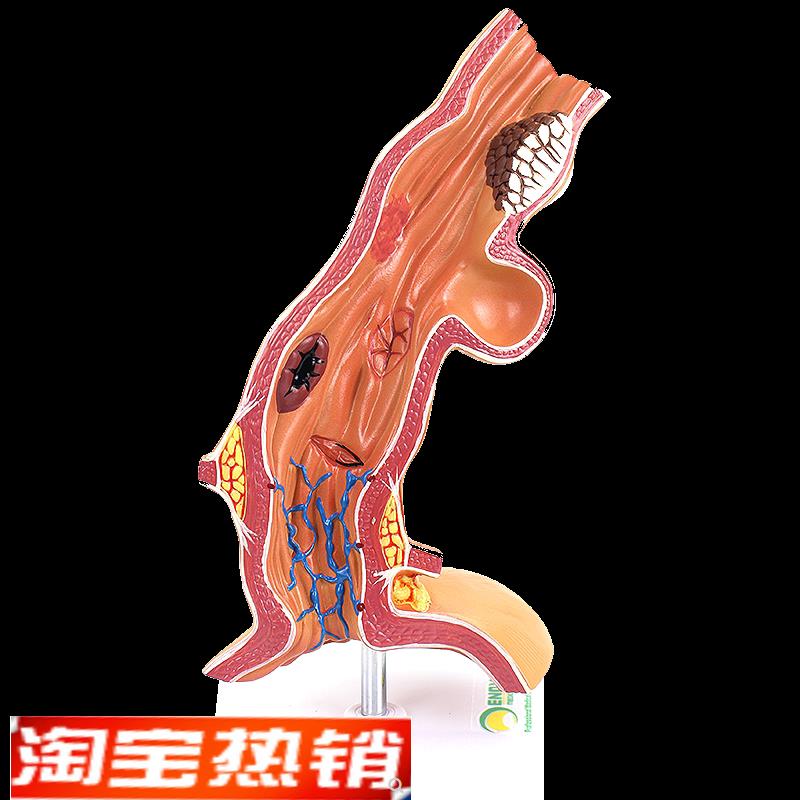ENOVO颐诺人体食管.疾病理模型