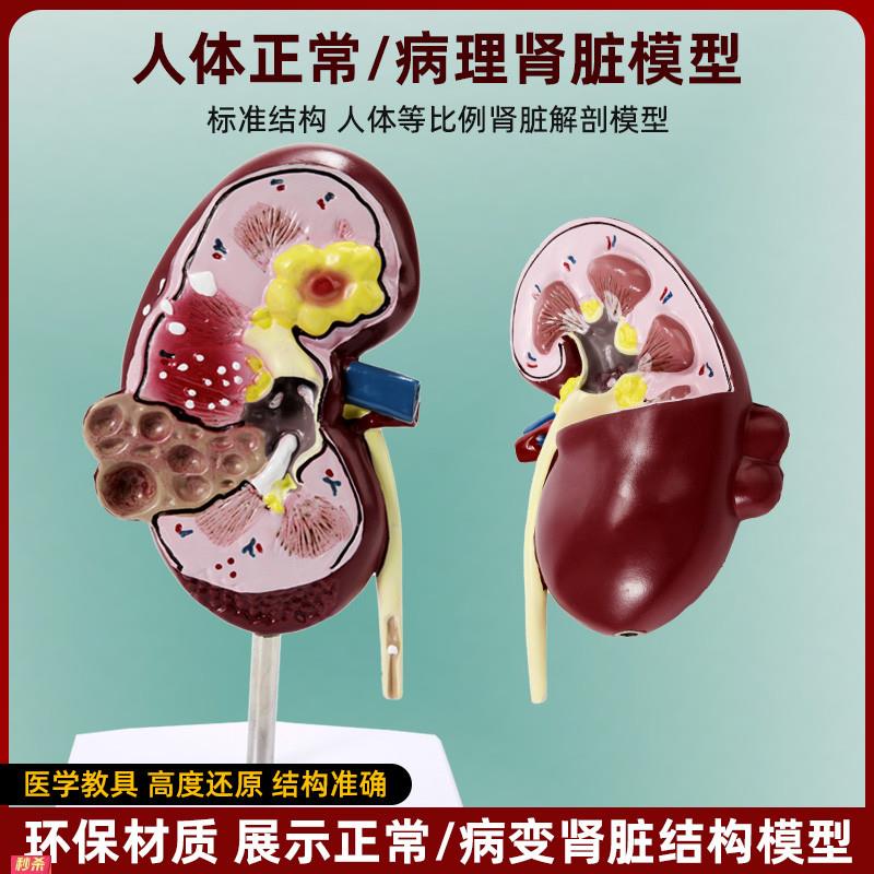 人体肾脏器官结构解剖模型病理肾医院内脏科摆件学校医学演示教具