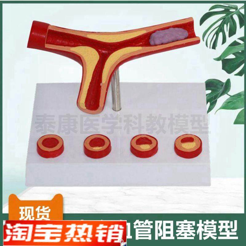 动脉血管模型脂肪斑块粥样阻塞栓C子硬化血压升高内膜变化医患沟