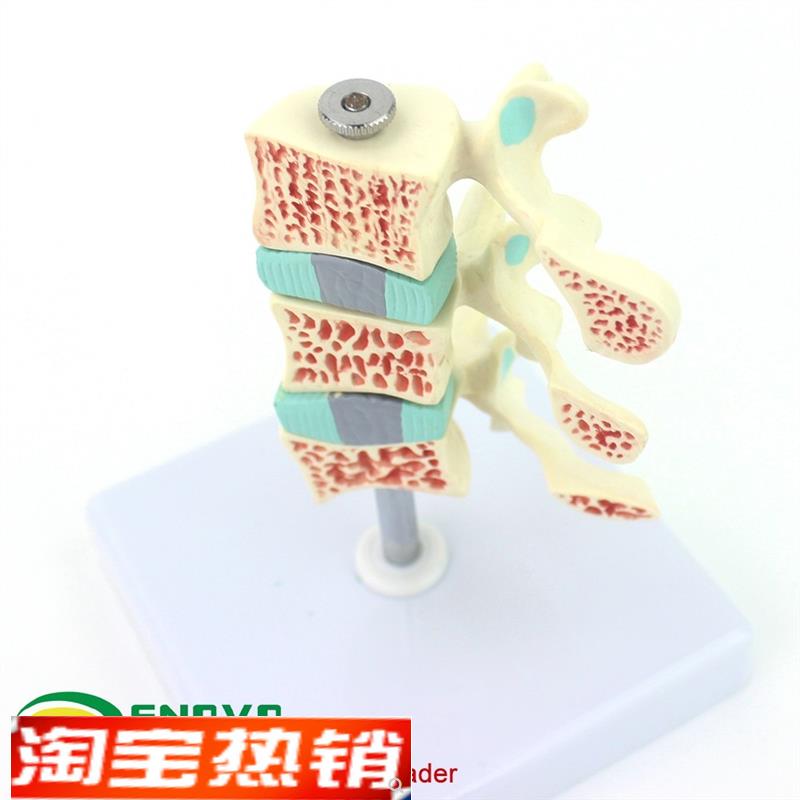 ENOVO颐诺人体骨质疏松症模型关节F骨质疏松模型人体椎间盘腰椎模