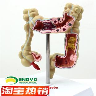 颐诺正品人体结肠病变模型w肛肠科消化科大肠模型医用人体解剖