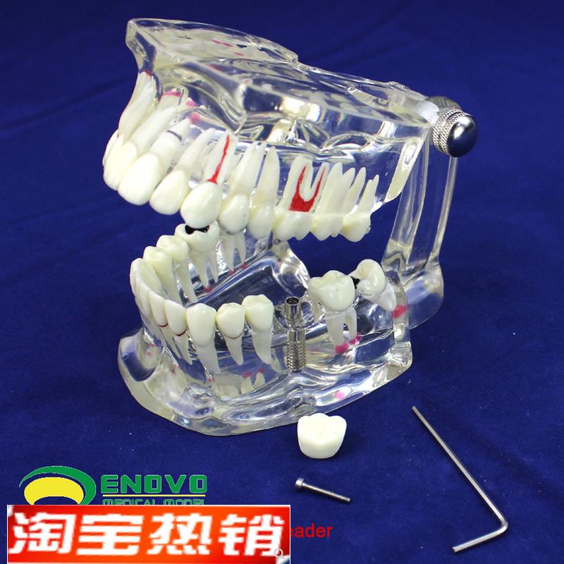 ENOVO颐诺牙齿模型口腔牙齿科种植模型口腔病理U模型种植体牙冠义