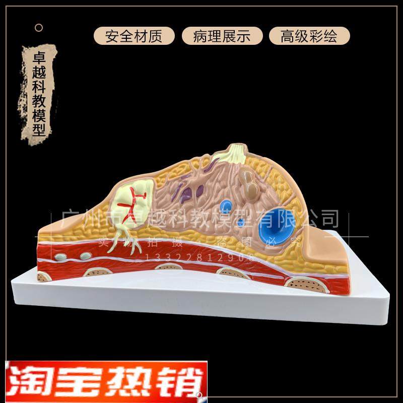 乳腺病变模型乳房模型乳t房病变模型解剖模型医用人体组织模型