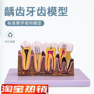 病态牙齿模型虫牙蛀牙牙病牙科疹所教具美牙牙Q洞修复牙龈发炎教