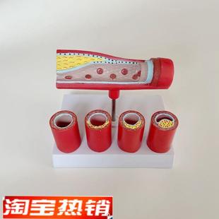 动脉血管阻塞模型粥样变化栓塞狭窄中H老年人血管心脏冠状动脉脂