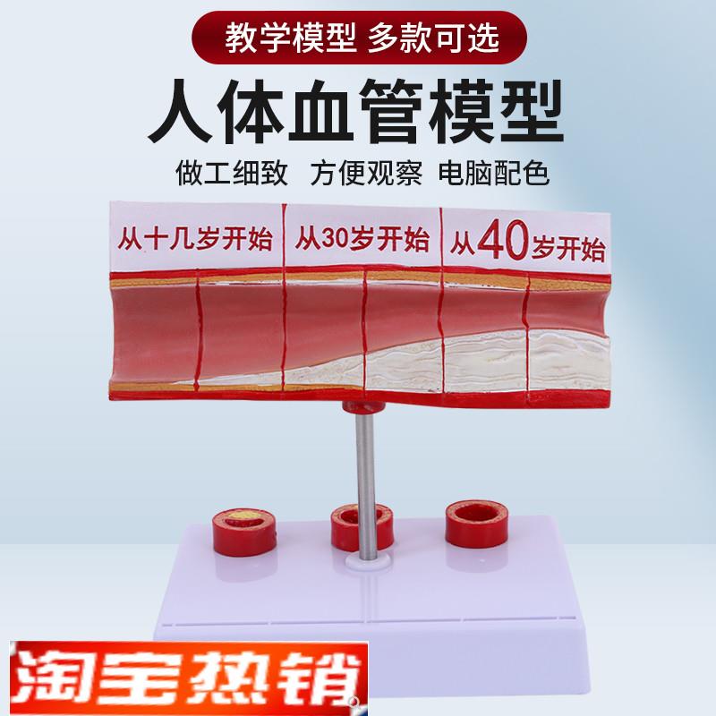 人体梗化支脉粥样n心血管动脉解剖梗化模型血管血全形成模型