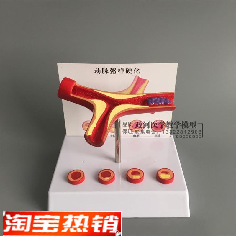 冠状动脉性心血管动脉硬化模型老K年心脏模型血栓形成