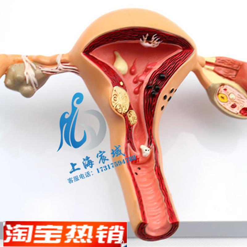 子宫卵巢病理病变模型生殖科女性H内外生殖器官模具教学病变
