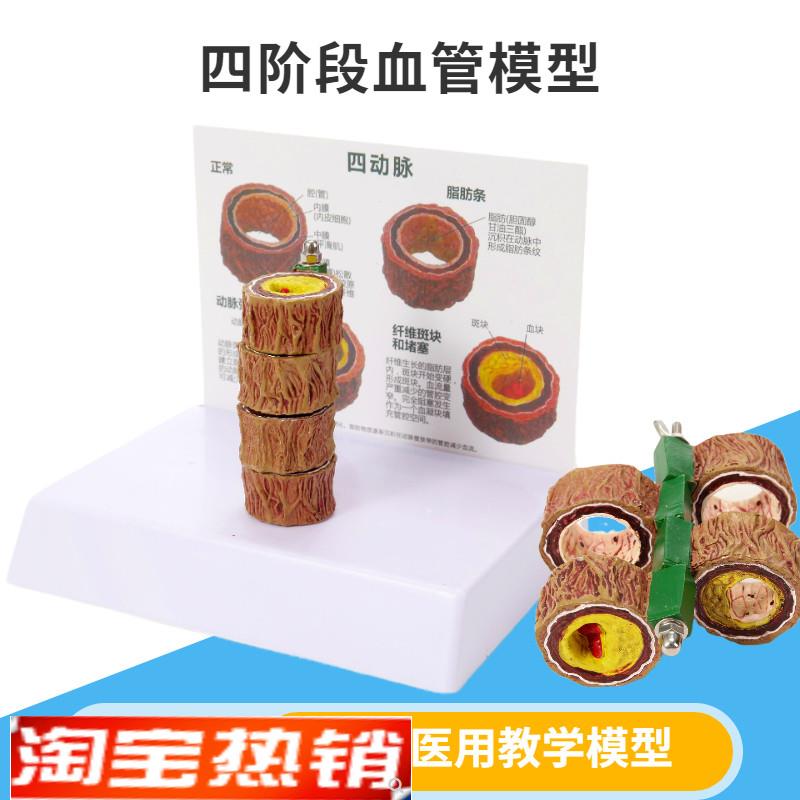 人体动脉粥d样血管模型血栓病变模型四阶段心血管模型示教内科玩
