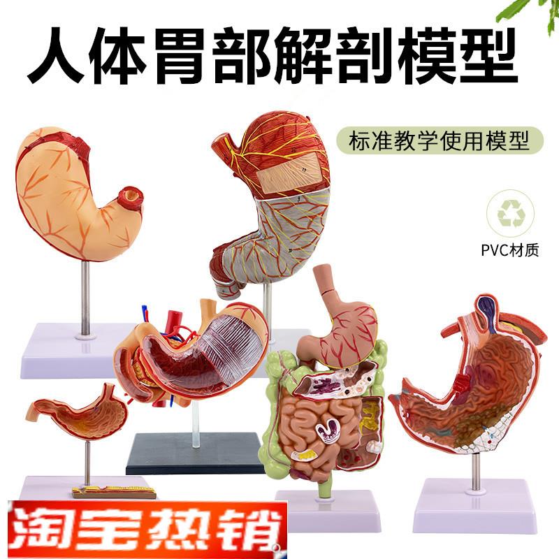 人体胃解剖模g型胃的病变模型胃部疾病胃的穿孔演示模型病理胃