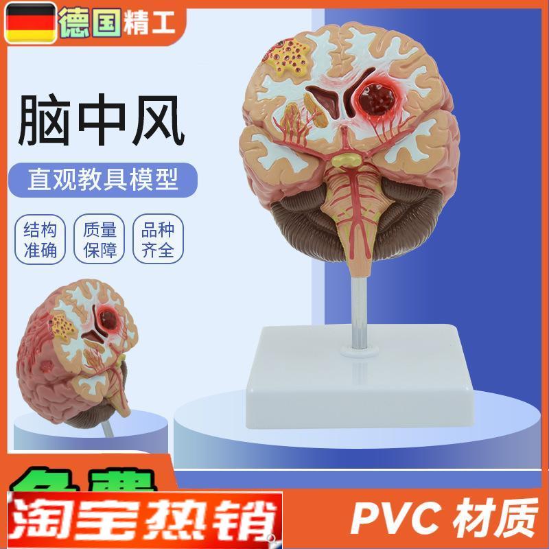 德国】人体脑解剖模型脑出血动脉大脑动静脉畸S形脑病理大脑教具