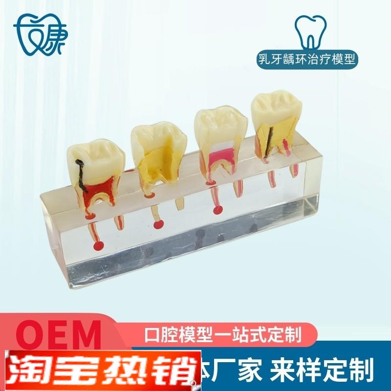 根管牙髓治疗模型牙科口腔教学牙模种植修复病P理模型医患沟通模