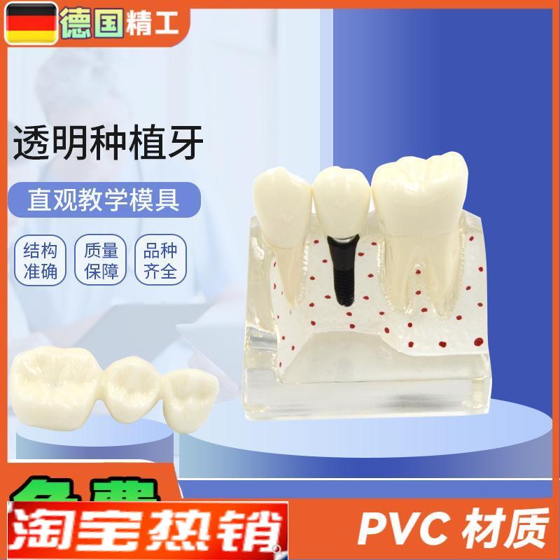 德国】透明种植牙模型牙科修复模型透明可拆T卸病理种植体牙