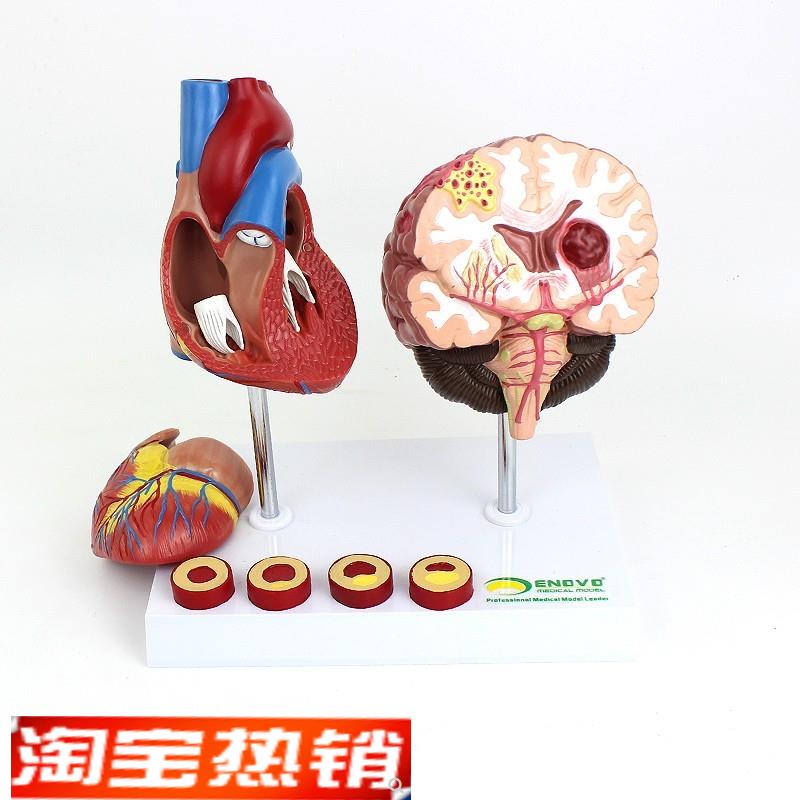ENOVO颐诺v心脑血管疾病展示模型