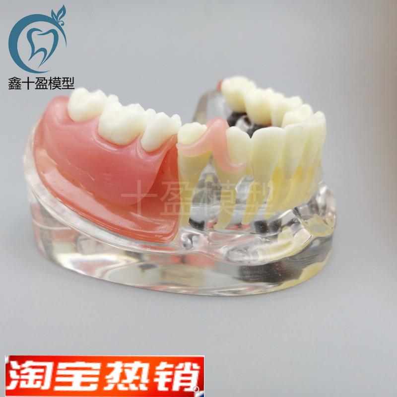 牙科口腔教学种植j与修复模型3颗钉模型微型种植医患沟通M6006